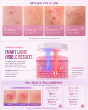 ClearBeam LED Acne & Pimple Spot Patches